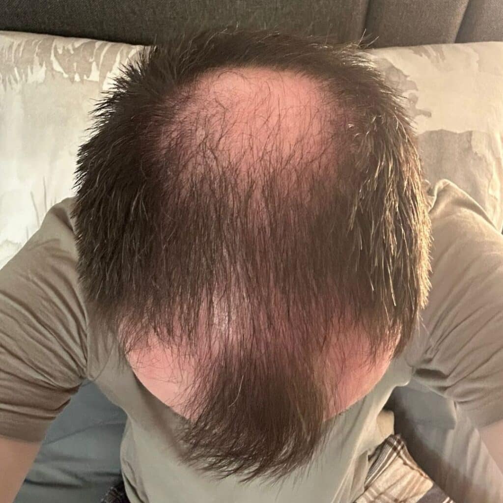 Real UK Patient Journey in Antalya for Hair Transplant and Cosmetic Dentistry