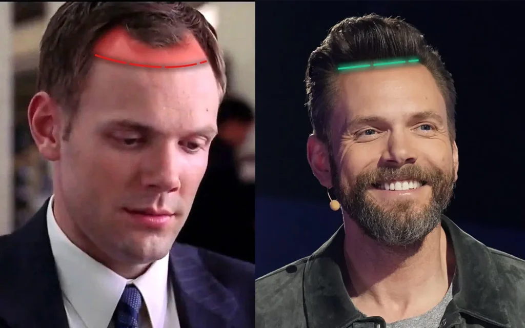 Joel McHale Hair Transplant